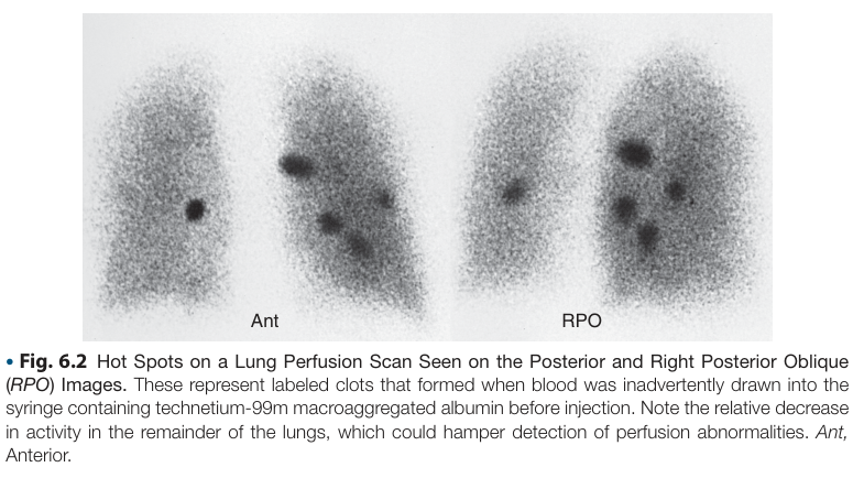VQ scans radiolabeled clots.png