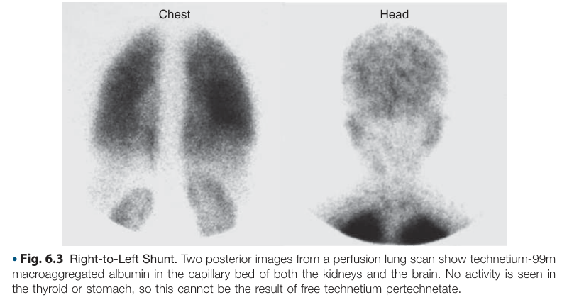 VQ scans right to left shunt.png