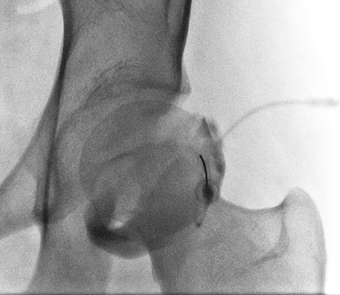 anterior hip injection approach.png