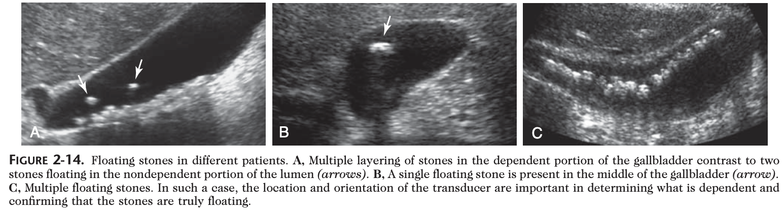 floating gallstones.png