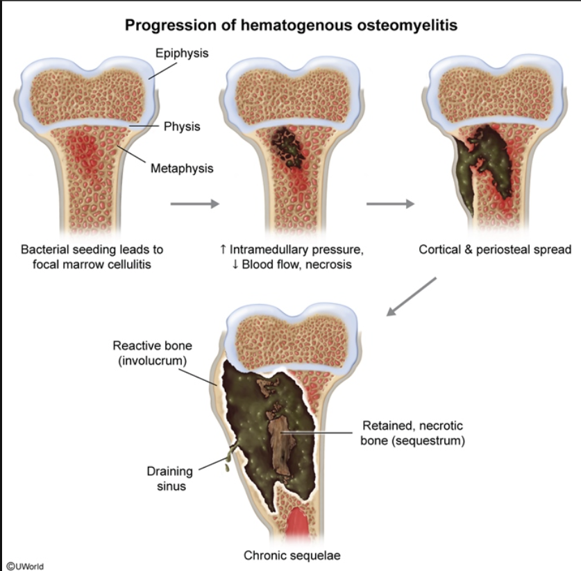 hematogenous osteomyelitis.png