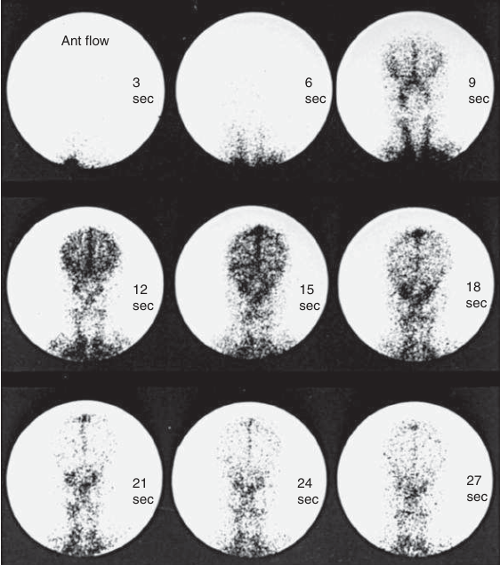 normal brain DTPA.png