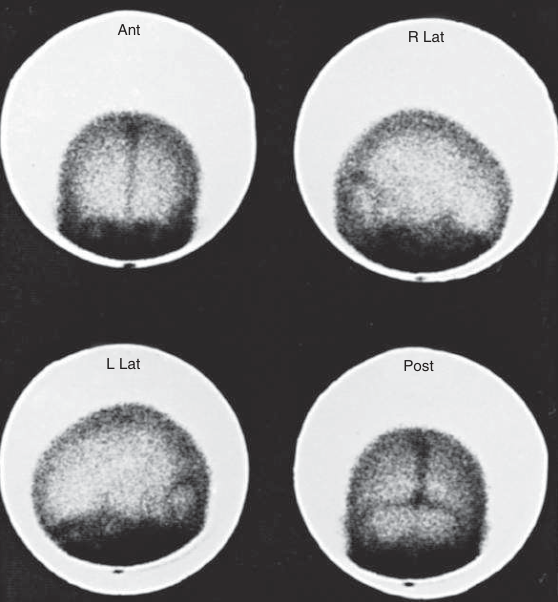 normal planar brain scan DTPA.png