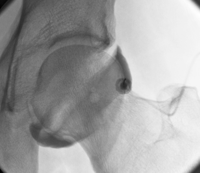 paracortical hip technique.png