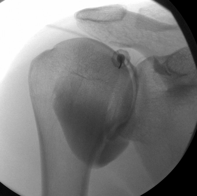 rotator interval approach.png